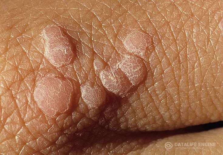 Basalioma - A leggyakoribb rosszindulatú bőrdaganat