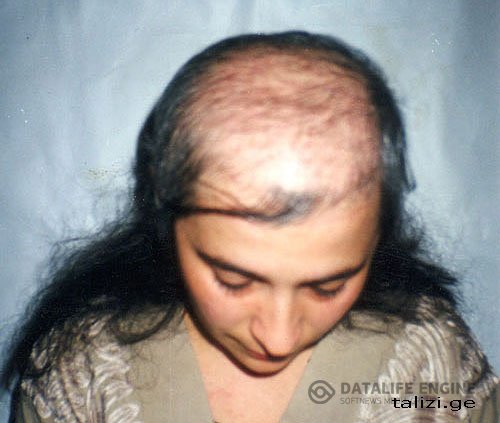 Выпадение волос » Лечение народной медициной на РецНарМед.ру