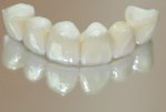 Несъемное протезирование: имплантация зубов, виниры